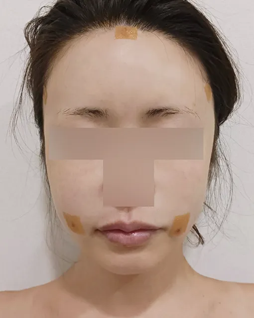 얼굴 지방이식 수술 1개월 후