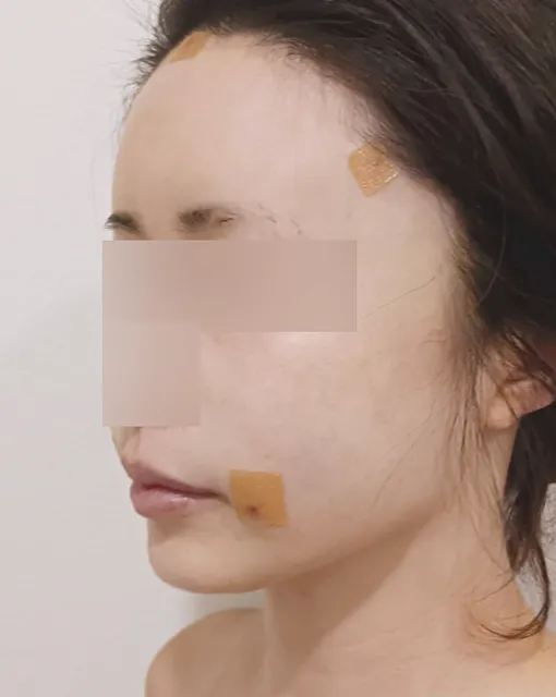 얼굴 지방이식 수술 1개월 후