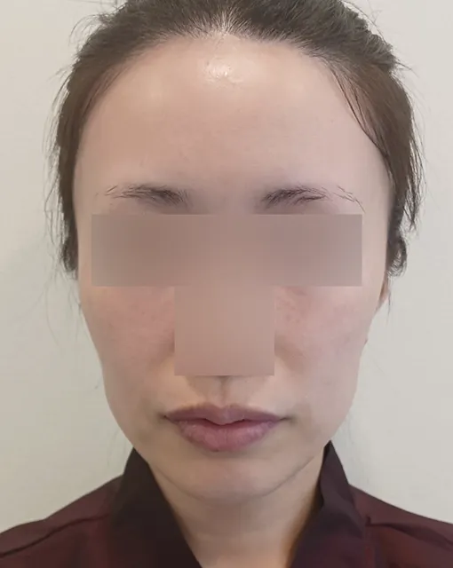 얼굴 지방이식 수술 전