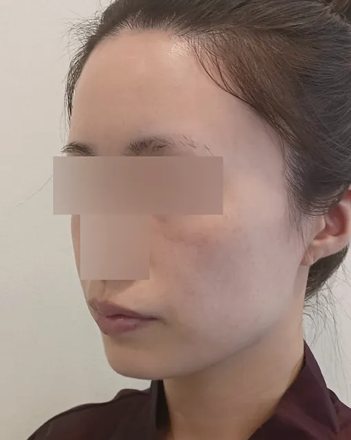 얼굴 지방이식 수술 전